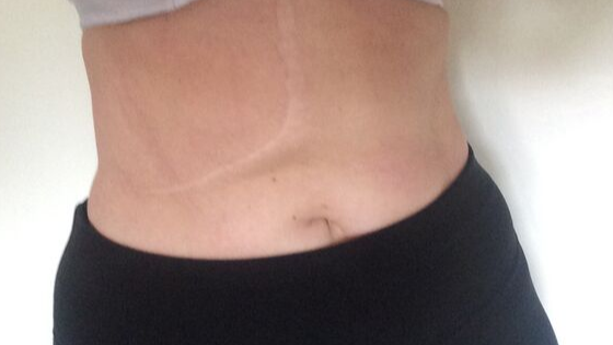 Never Be Ashamed Of Your Scars Many Of Us Have Physical Scars And Many By Bethan Bishop Medium