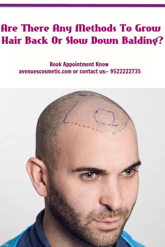 Are There Any Methods To Grow Hair Back Or Slow Down Balding