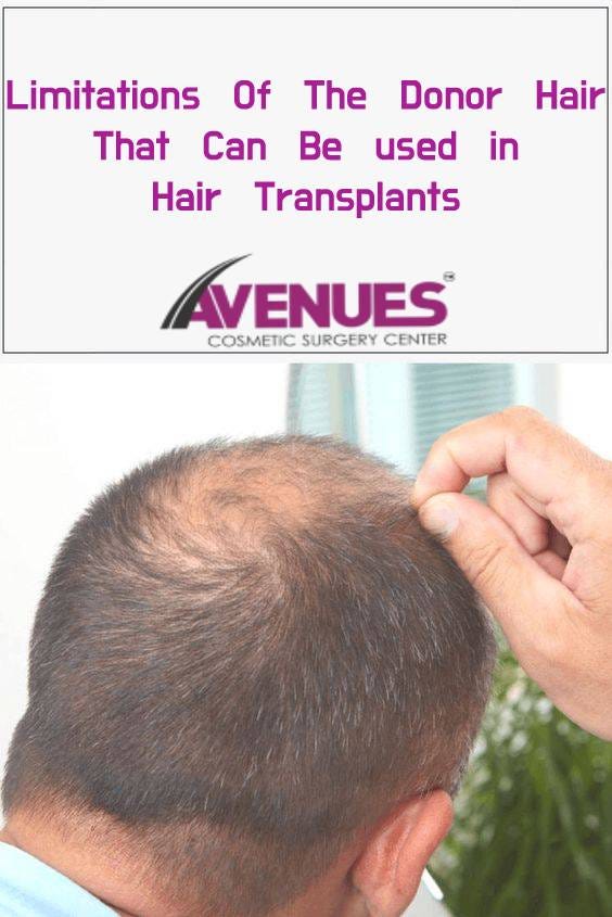 Limitations Of The Donor Hair That Can Be Used In Hair Transplants