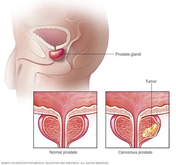 enuresis és prostatitis)