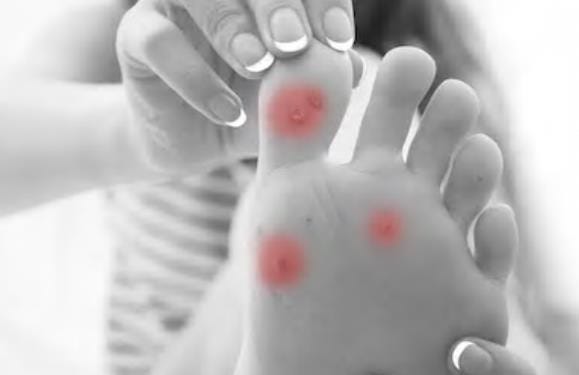 corn in feet ayurvedic treatment