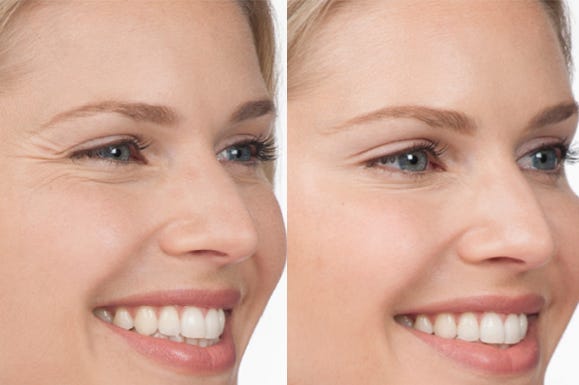mesotherapy for face