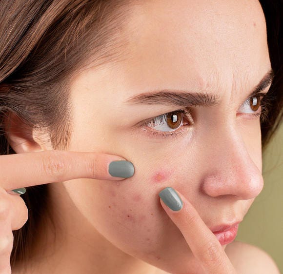 Stop Popping Pimples on Your Face, the Side Effects Can be Dangerous