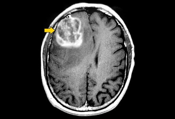 brain mri scan tumor