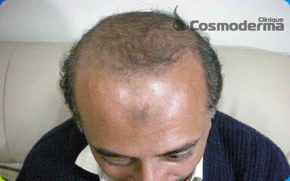 Get Services Of A Best Hair Transplant Surgeon Johnruse Medium