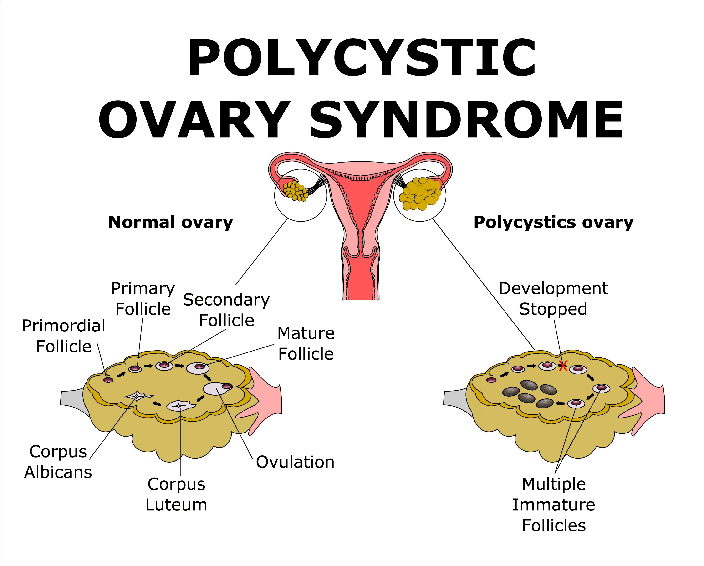 pcos latest research