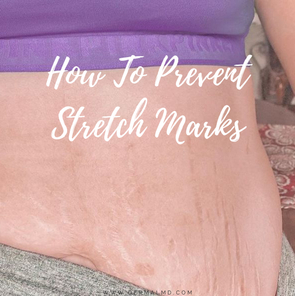 dermalmd stretch mark