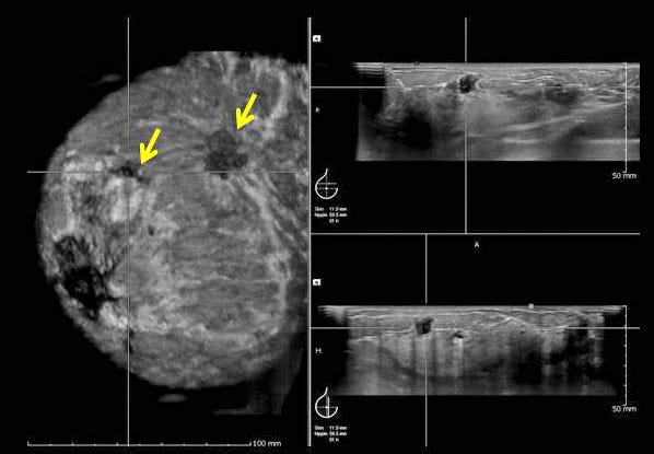 Breast Ultrasound And Its Benefits Angela Carter Medium - 