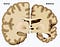 Tratamento Natural para Alzheimer