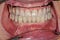 Permanent_Teeth_6_Implants_Dentures