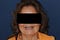 Denture_Six_Dental_Implants_Fixed_Dentaduras