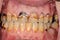 History of Drug Addiction and Losing Teeth