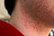 razor-burns-675x450