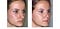 Before and after photographs of a rhinoplasty patient.