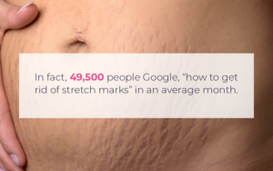 hydrocortisone stretch marks