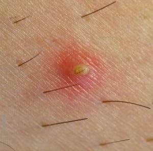 Is Your Skin Rash An Std Rash Cupidcare Medium