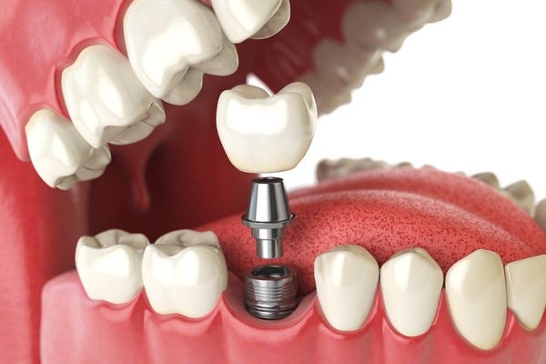 What to Expect During Dental Implant Treatment | by Teethwhiteningweb | Medium