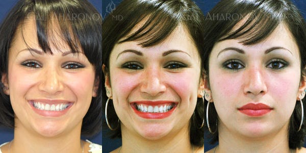 Dimples Surgery Before And After Core Plastic Surgery