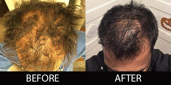 Scientific Hair Recuperation Getting Your Hair Back Permanently