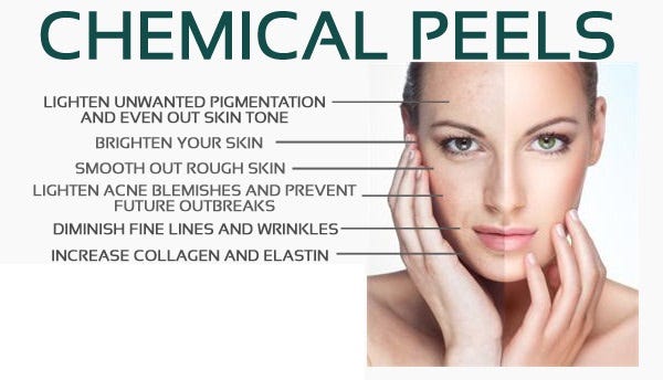 chemical peel for acne