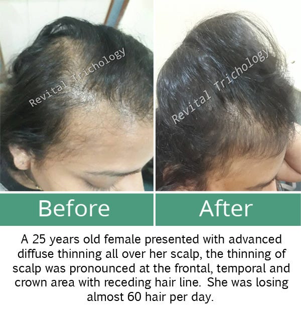 Best Hair Transplant Surgery In Mumbai Revital Trichology