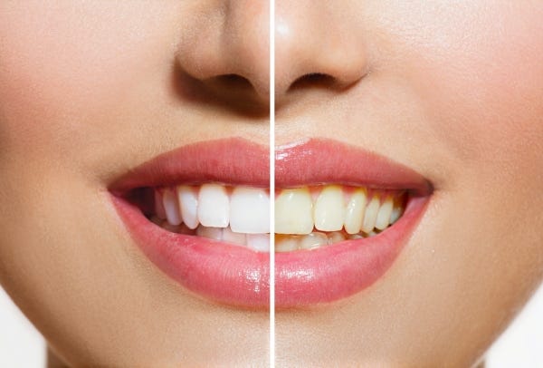 Five Teeth Whitening Myths Debunked By Paul Binon Dds Msd Fao And Associates Medium