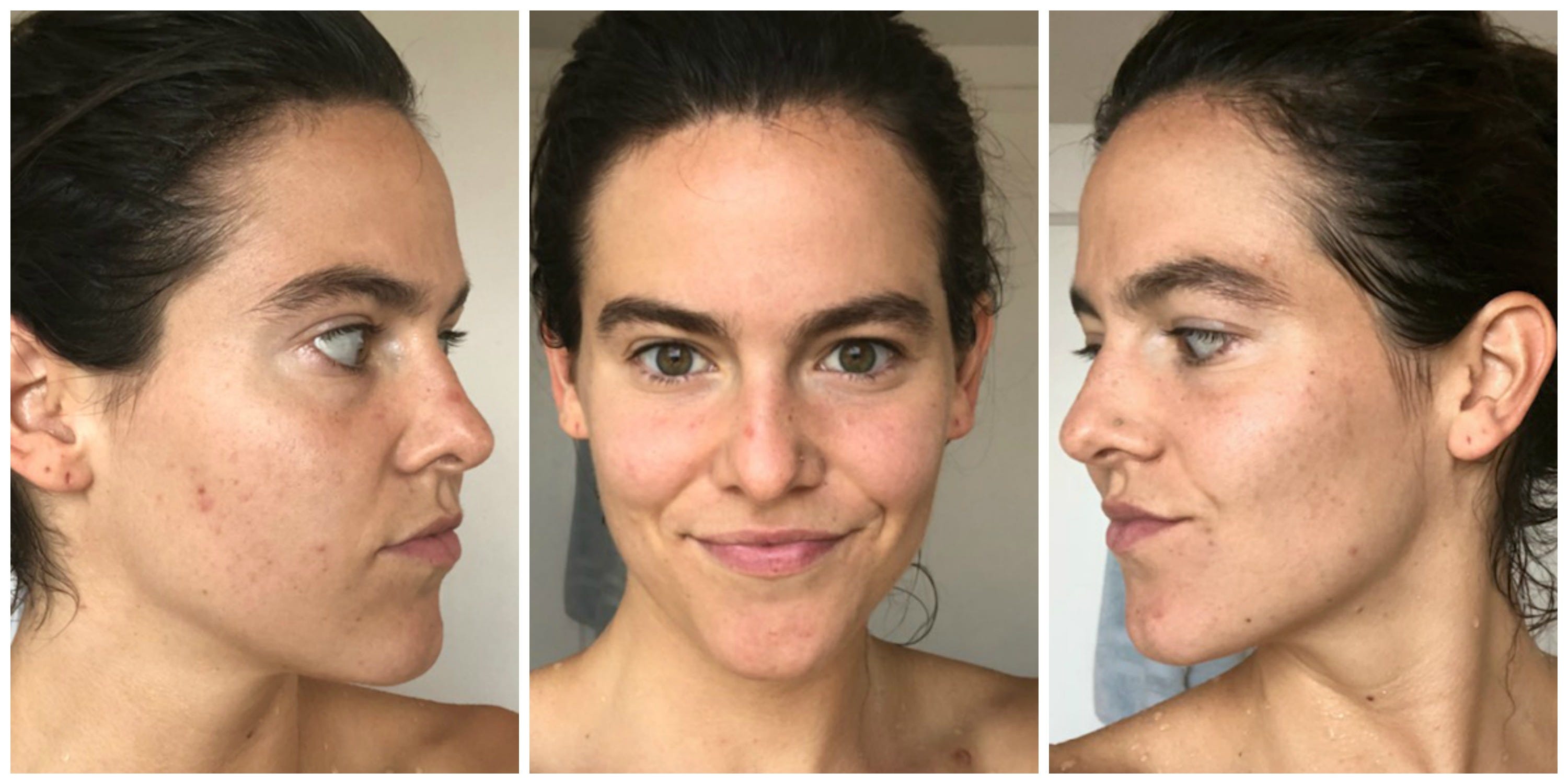 My Skincare Journey, Continued: How I Finally Stopped Picking My Face [Part  2] – CHAARG