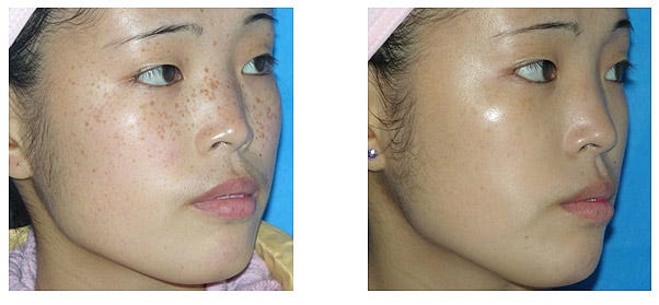 pigmentation removal