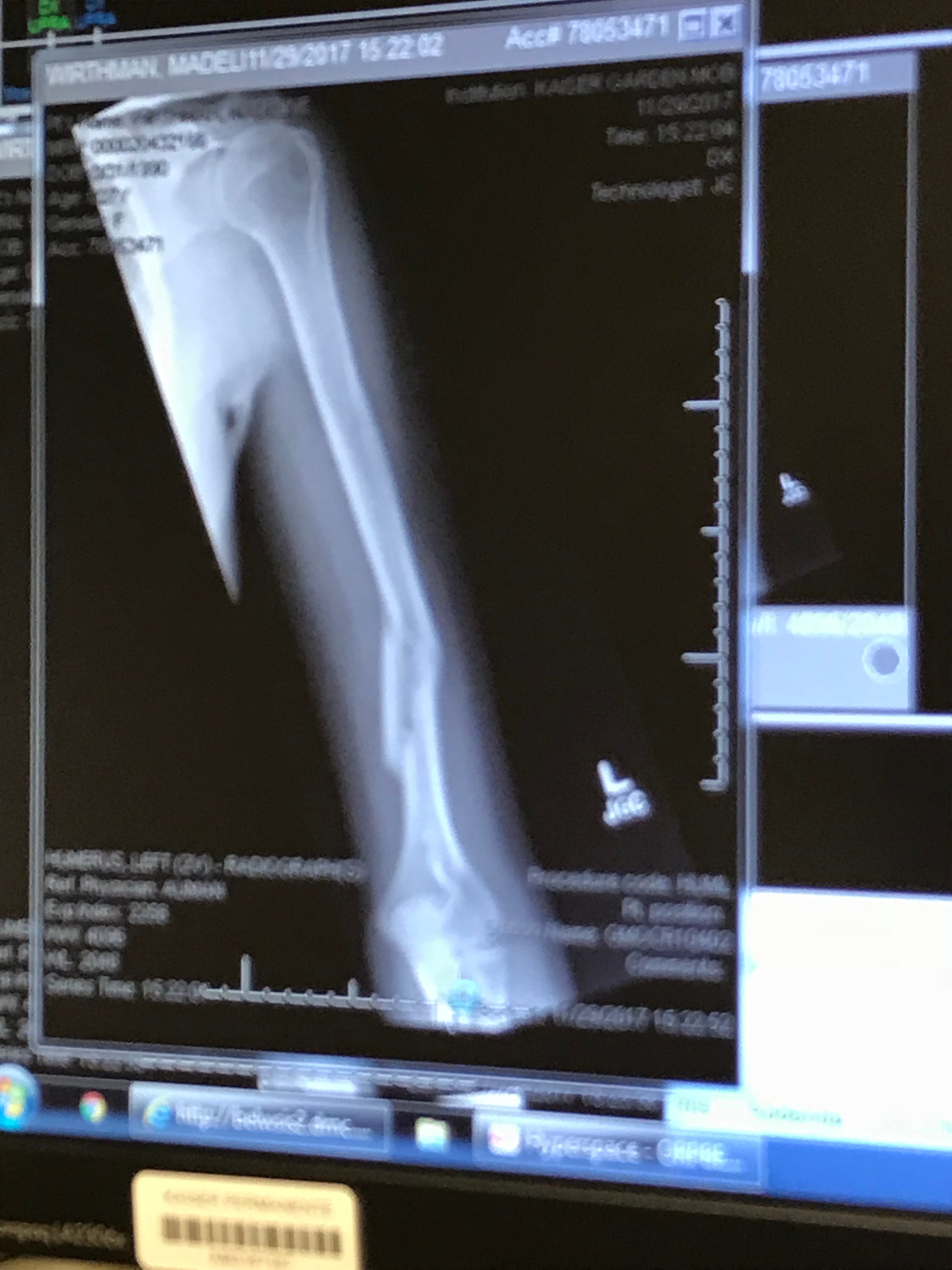 A Broken Humerus — Road to Recovery by Maddie Wirthman Medium