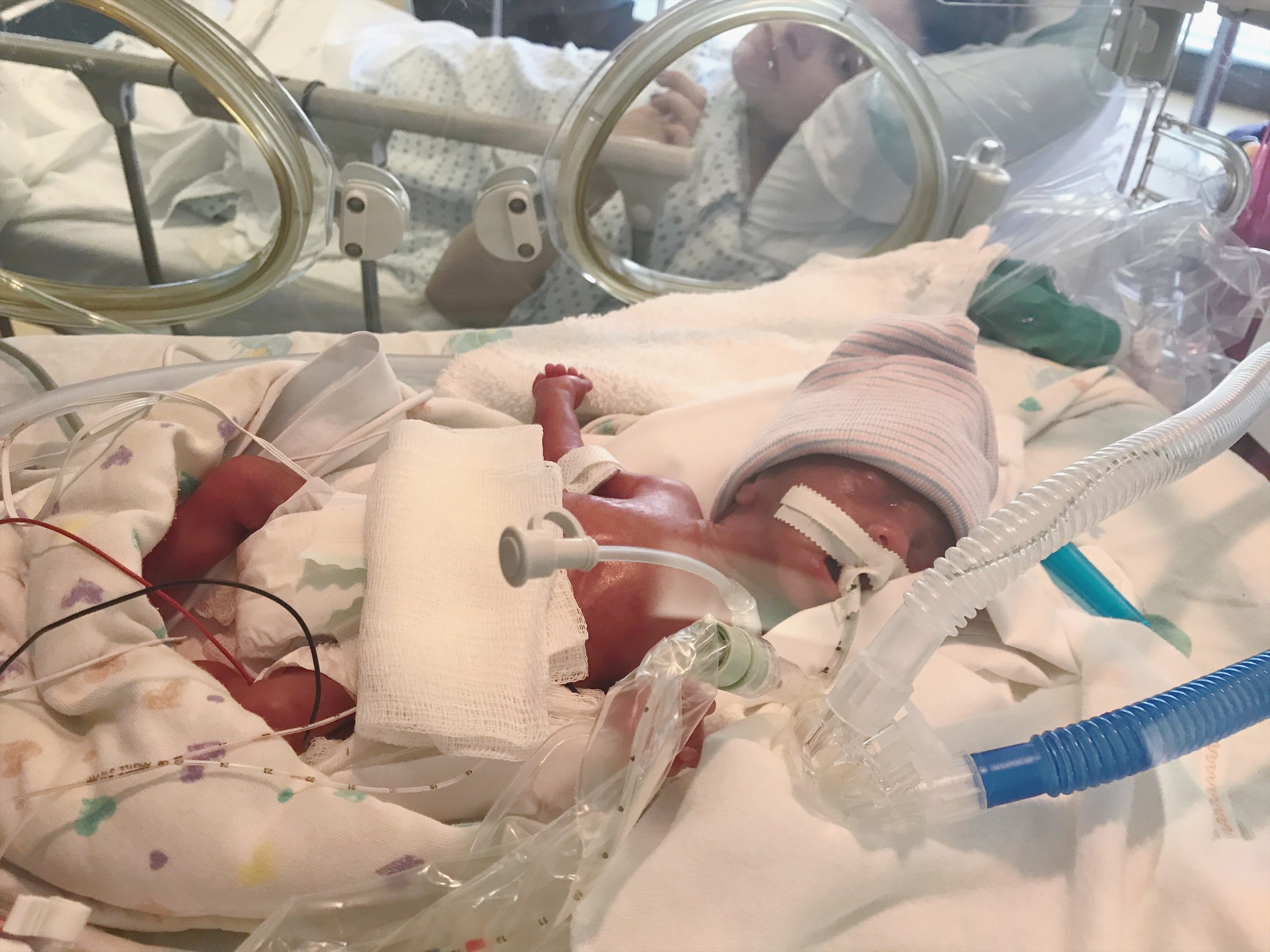 Jack and Ben’s Birth Story. Jack and Ben are mono-di twins. Mono-di ...