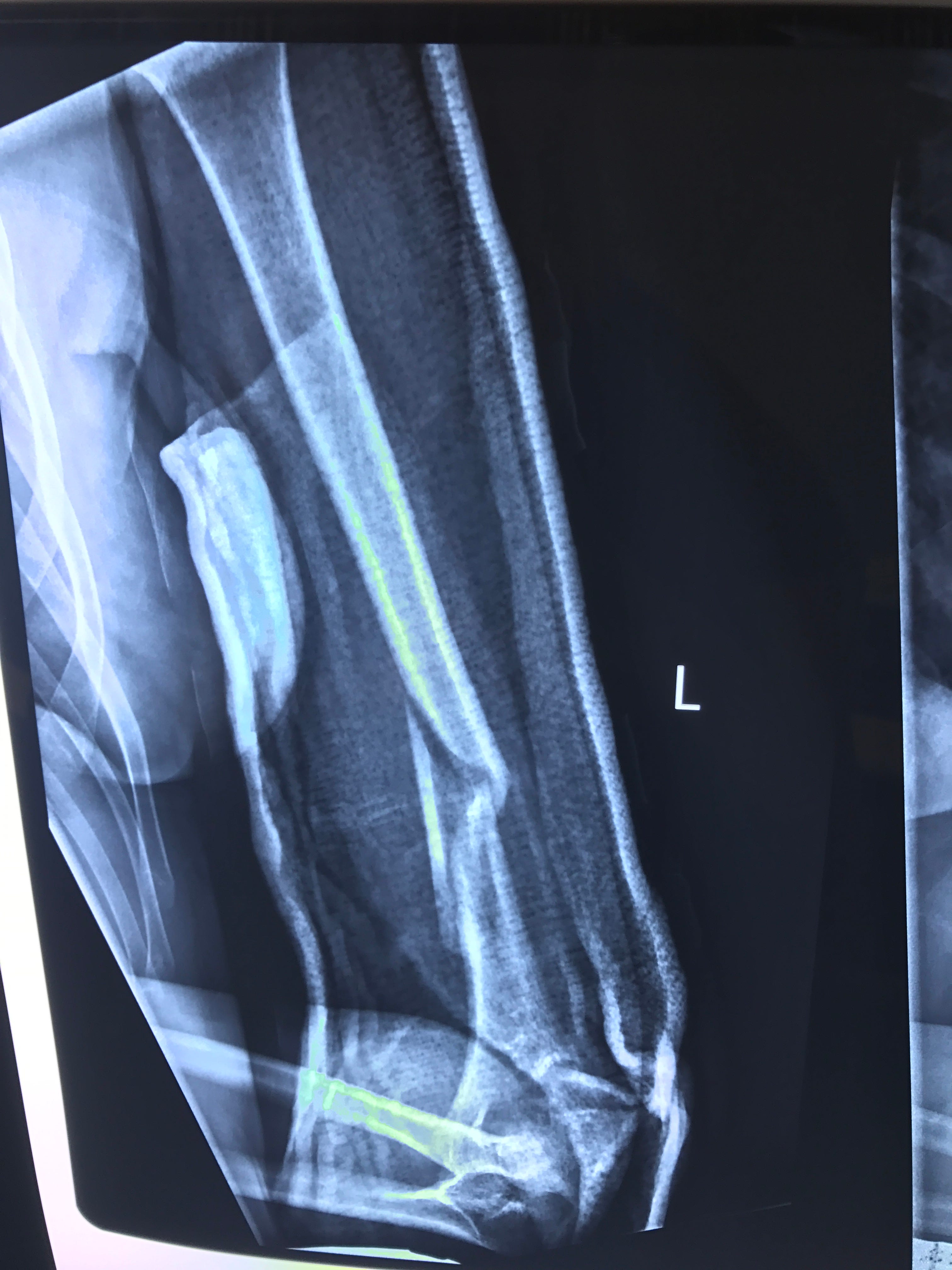 A Broken Humerus — Road to Recovery by Maddie Wirthman Medium