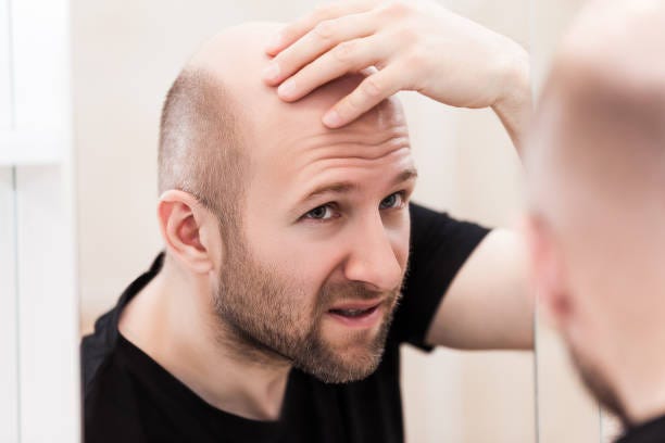 What Is The Average Cost Of Hair Transplant Sean Mandoza Medium