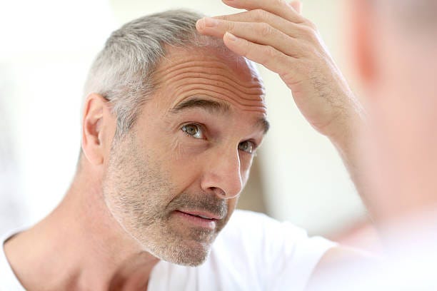 6 Things Men Need To Learn About Hair Loss Nyjon Eccles Medium