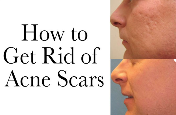 Spots rid of to get How To