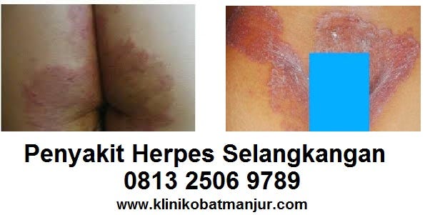 cara mengobati herpes di selangkangan by Obat Penyakit Herpe