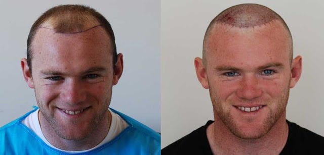 Best Hair Transplant In St Louis Mo Revive Hair Restoration
