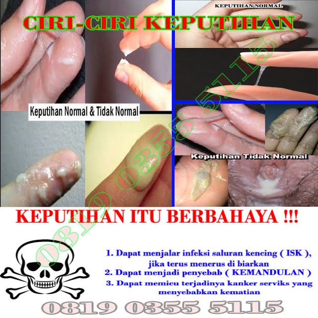 30 Trend Terbaru Cara Mengatasi Keputihan Yang Bau Secara Alami Daliono Novitasari