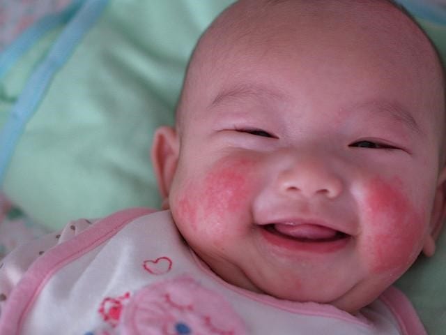 Baby Eczema Causes And Treatments By Baby Care Medium