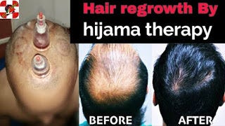 How I Regrow Hair Naturally By Hijama Therapy Abdul Rahman Medium