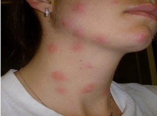 What S Biting You At Night 5 Bugs That Are Leaving Nasty Red Bite Marks On Your Skin While You Are Asleep By Jason Dickson Medium