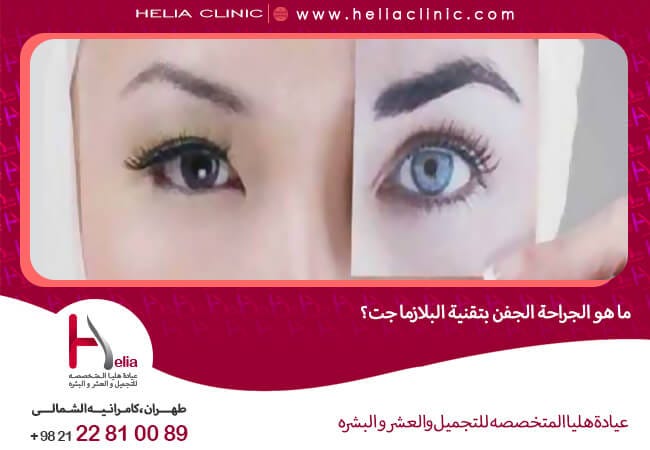 ما هي جراحة الجفون باستخدام تقنية البلازما جت؟ بواسطة عيادة هاليا المتوسطة