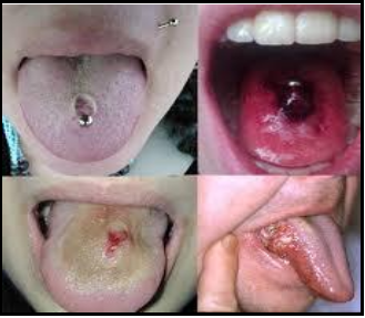 Tongue Piercing A Stylish Art But Can Be Risky For Oral Health By Jagdish Sahu Medium