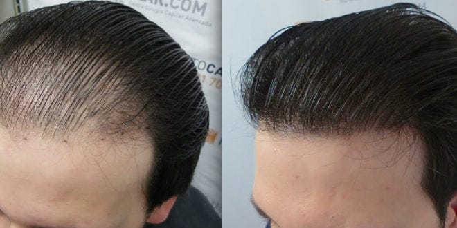 The Best Hair Transplant Guide Hair Transplant By Samarth Sonawane Medium