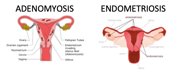 Endometriosis vs Adenomyosis - Vasundhara - Medium