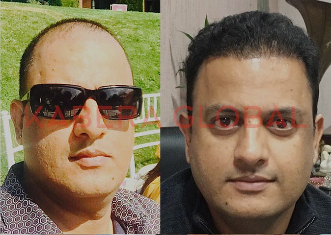 Kabera Global Best Hair Transplant Clinic In Delhi