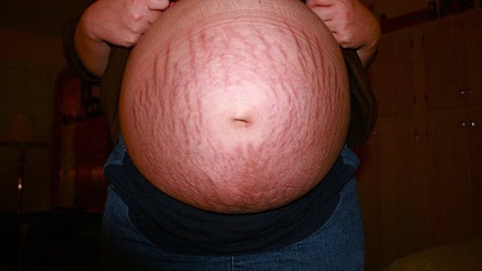 Stretch Marks In Pregnancy Causes Prevent Treatment By Rawan Az Medium