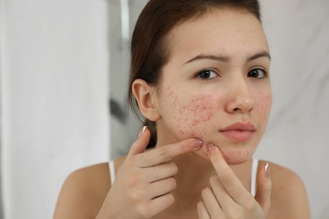 best way to treat adult acne