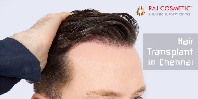 Hair Transplant In Chennai Shwathi21 Medium