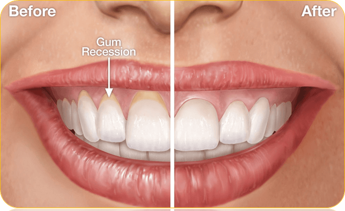 Why Are My Gums Receding?