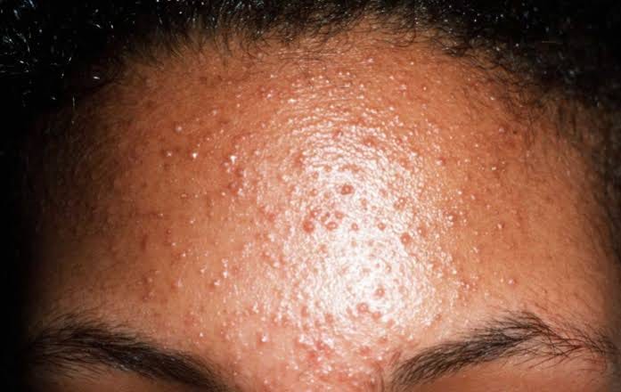 malassezia-folliculitis-malassezia-folliculitis-commonly-known-by